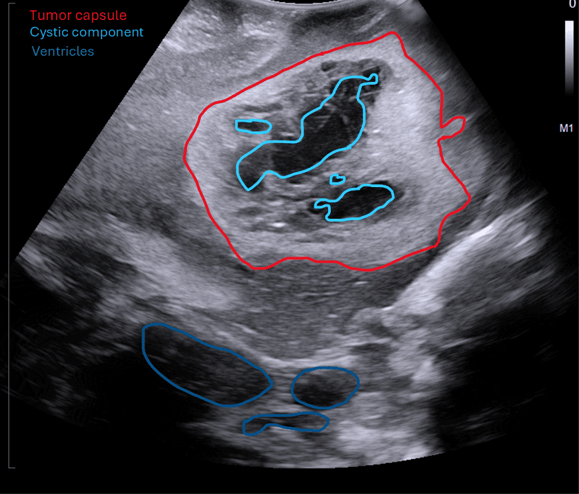 Intraoperative neurosurgical ultrasound showing brain tumor capsule, cystic component and ventricular relationship — with anatomy labels
