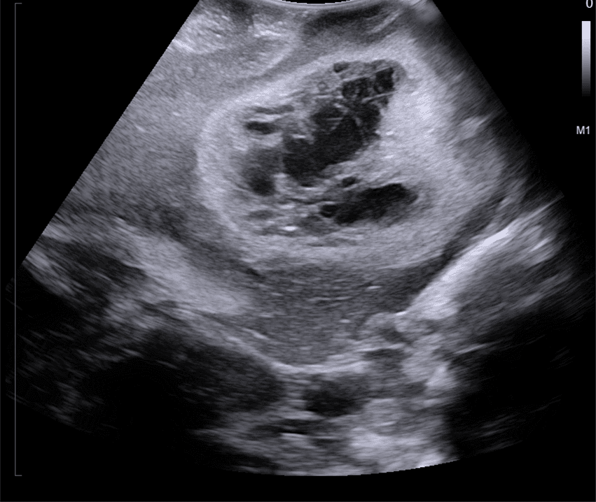 Intraoperative neurosurgical ultrasound showing brain tumor capsule, cystic component and ventricular relationship