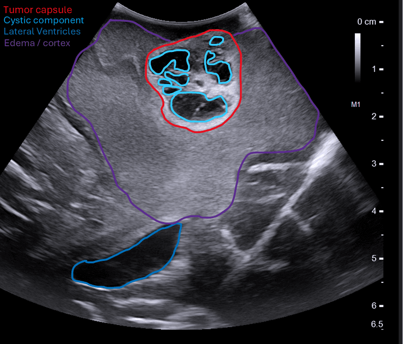Intraoperative ultrasound of brain tumor with lateral ventricles, edema and cortex — with anatomy labels
