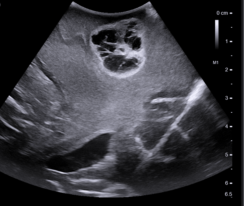 Intraoperative ultrasound of brain tumor with lateral ventricles, edema and cortex