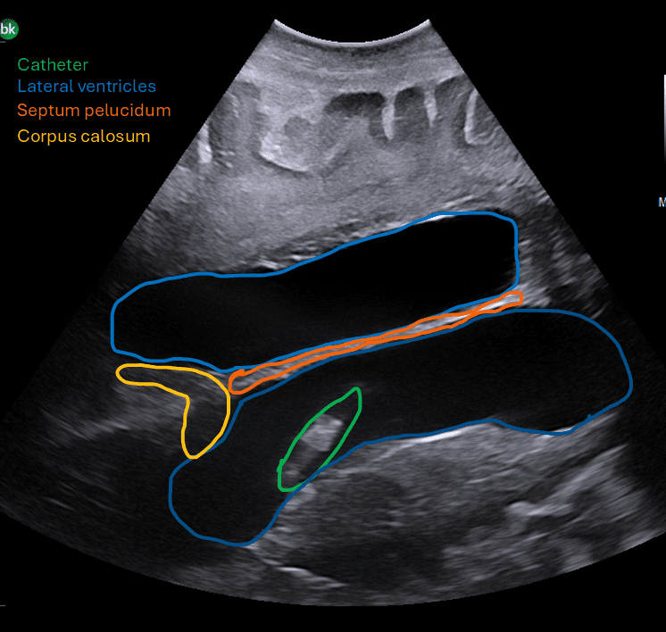 Intraoperative ultrasound showing ventricular catheter with lateral ventricles, septum pellucidum and corpus callosum — with anatomy labels