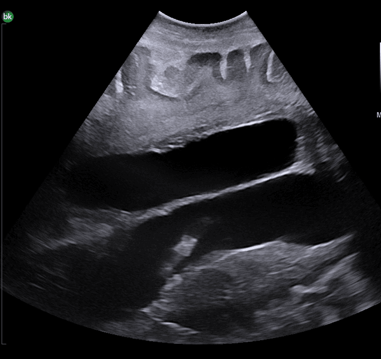 Intraoperative ultrasound showing ventricular catheter with lateral ventricles, septum pellucidum and corpus callosum