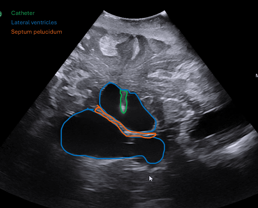 Intraoperative ultrasound showing ventricular catheter adjacent to lateral ventricles and septum pellucidum — with anatomy labels