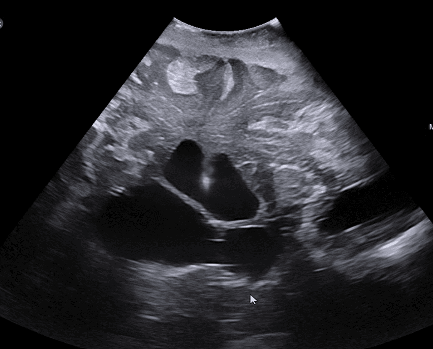 Intraoperative ultrasound showing ventricular catheter adjacent to lateral ventricles and septum pellucidum