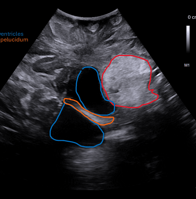 Intraoperative ultrasound showing intraventricular tumor with lateral ventricles and septum pellucidum — with anatomy labels