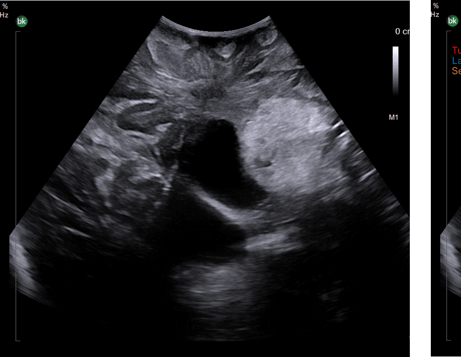 Intraoperative ultrasound showing intraventricular tumor with lateral ventricles and septum pellucidum