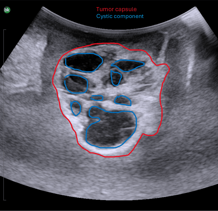 Intraoperative ultrasound showing brain tumor with well-defined capsule and cystic component — with anatomy labels