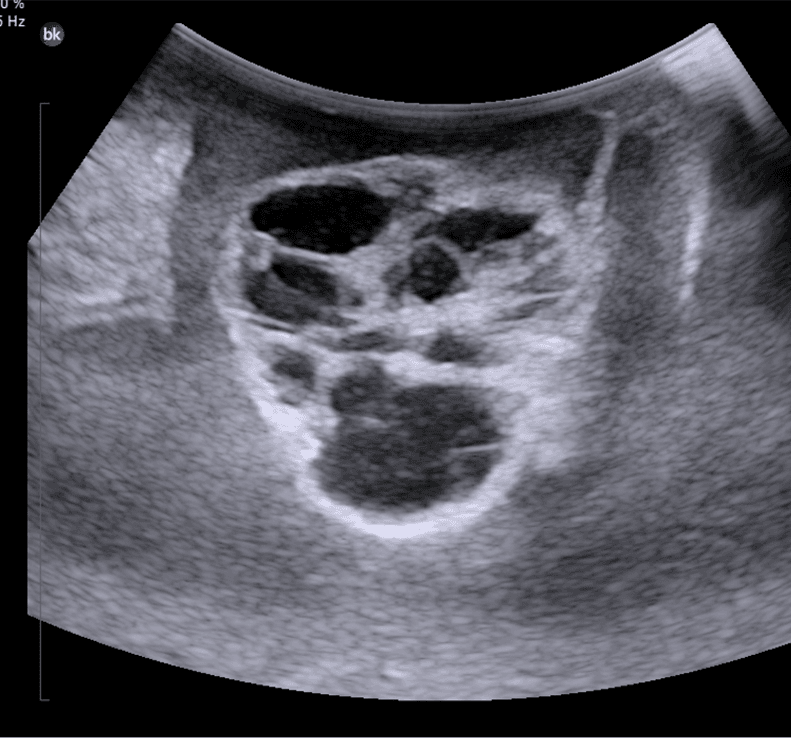 Intraoperative ultrasound showing brain tumor with well-defined capsule and cystic component