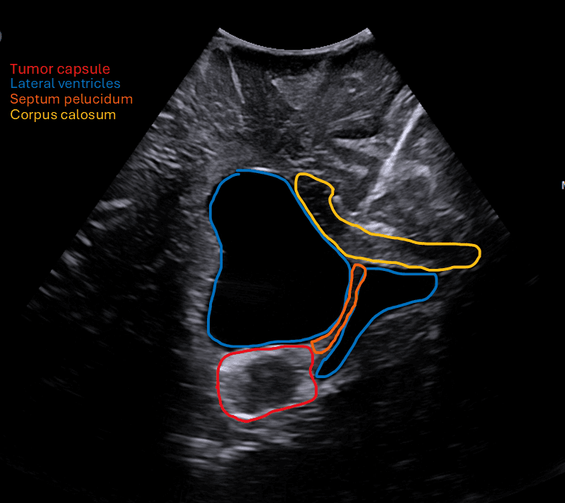 Intraoperative ultrasound showing brain tumor with lateral ventricles, septum pellucidum and corpus callosum — with anatomy labels
