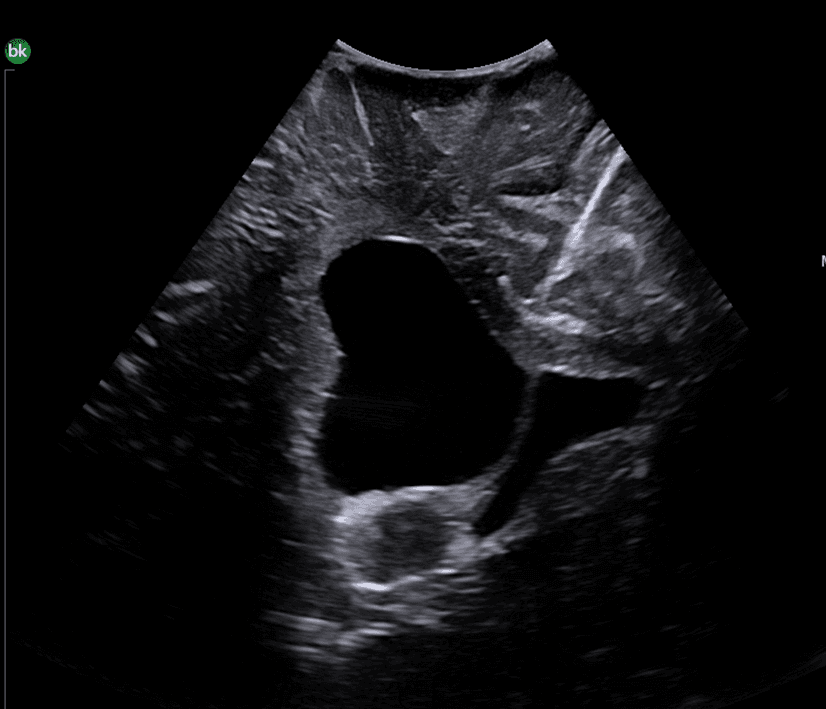 Intraoperative ultrasound showing brain tumor with lateral ventricles, septum pellucidum and corpus callosum